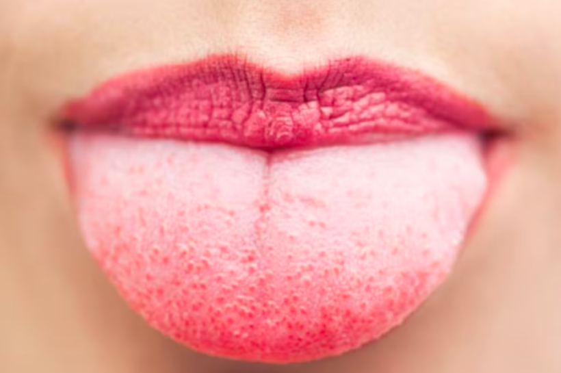 Conoce cómo la lengua puede revelar problemas de salud